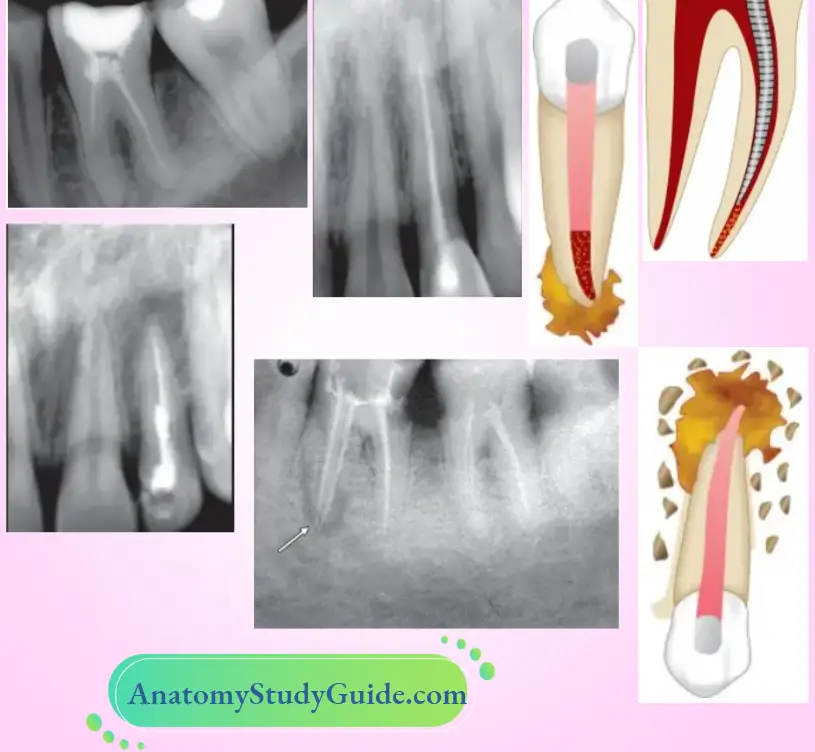 Procedural Accidents Obturation Related