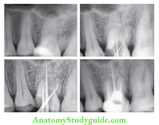 Procedural Accidents Perforation management in maxillary right fist molar using MTA