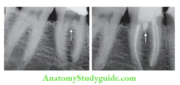 Procedural Accidents Perforation repair of mandibular fist molar using MTA-Preoperative radiograph; Postoperative radiograph