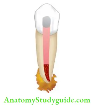 Procedural Accidents Persistent bacterial infection in root canal with filing short of apex causes treatment failure.
