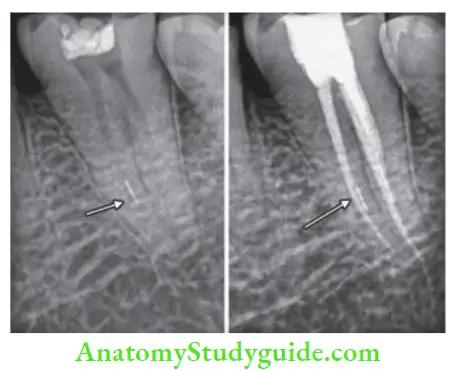 Procedural Accidents Preoperative radiograph showing separated instrument; Postoperative radiograph showing separated instrument incorporated in fial obturation.