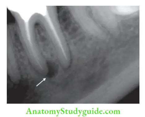 Procedural Accidents Radiograph showing J-shaped radiolucency around mesial root of mandibular molar with vertical root fracture