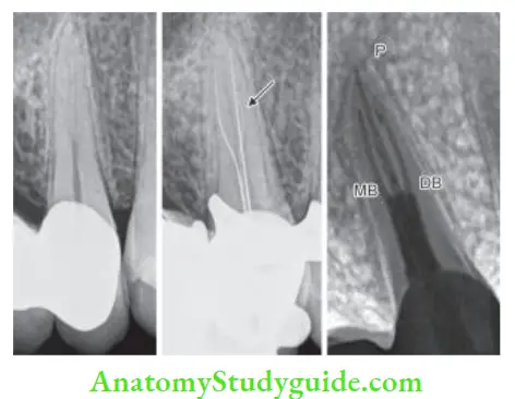 Procedural Accidents Radiograph showing fast break in maxillary first premolar, i.e. one main canal almost becomes untraceable as we go apically