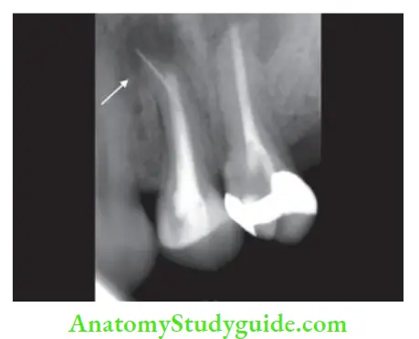 Procedural Accidents Radiograph showing fractured instrument going beyond apex in maxillary premolar.