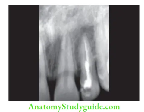 Procedural Accidents Radiograph showing inadequate obturation and periapical radiolucency in relation to left maxillary lateral incisor