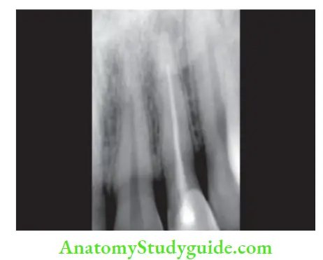 Procedural Accidents Radiograph showing incomplete obturation