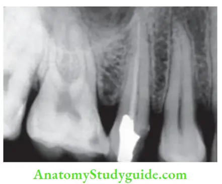 Procedural Accidents Radiograph showing missed canal in maxillary second premolar.