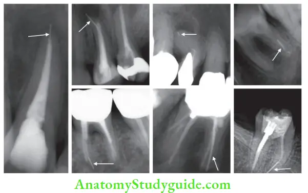 Procedural Accidents Radiographs showing separated instruments.