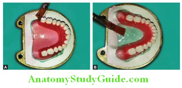 Processing Of Waxed Up Denture application of cold mould seal on first pour