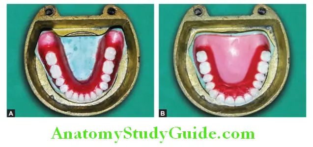 Processing Of Waxed Up Denture checking clearance of casts in denture flask