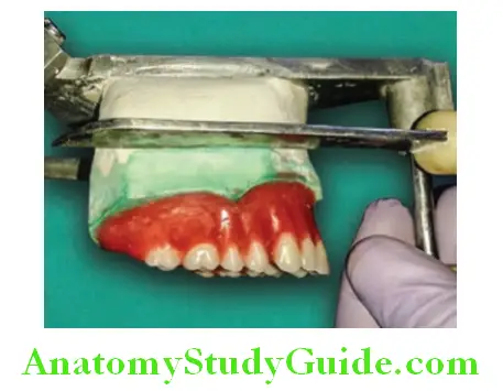 Processing Of Waxed Up Denture demounting the cast