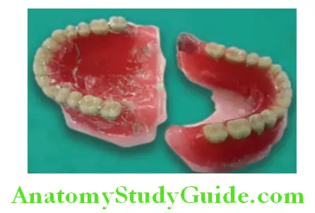Processing Of Waxed Up Denture maxillary and mandibular dentures retrieved from investment