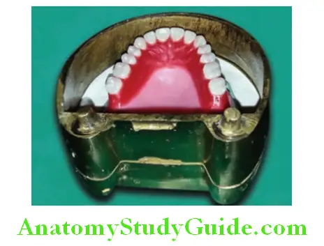 Processing Of Waxed Up Denture place the counter and check that the teeth are within height of the flask