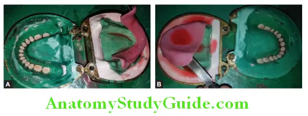 Processing Of Waxed Up Denture removal of temporary record base