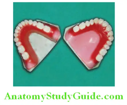 Processing Of Waxed Up Denture sealed maxillary and mandibular trial denture on casts