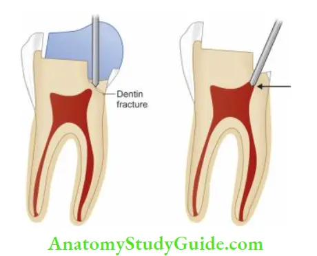 Pulpal Response To Caries And Dental Procedure Dentinal fracture or pulpal exposure can occur due to pin placement.