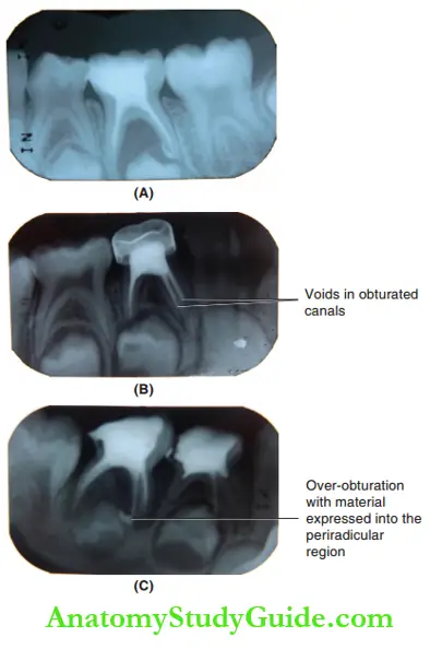 Pulpectomy In Primary Teeth Post Operative IOPA Radiographs Showing Difference In The Quality Of Oburation