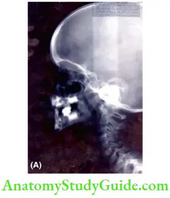 Radiographic Investigation Lateral Cephalogram Of A 4 Year Old Boy With Pierre-Robin Anomalad