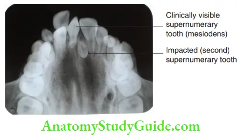 Radiographic Investigation Maxillary Occlusal Radiograph Localising The Impacted Supernumerary Teeth
