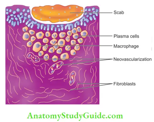 Rationale Of Endodontic Treatment Notes Inflammatory cells present at the healing site.
