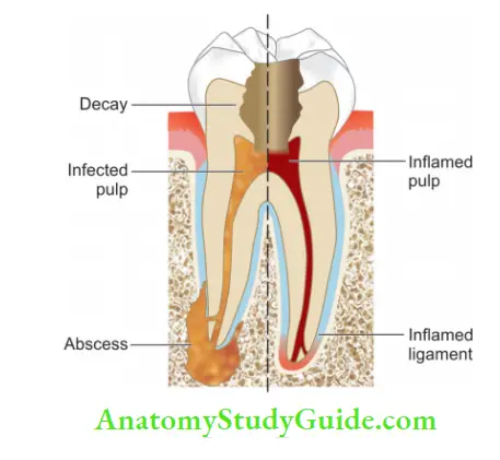 Rationale Of Endodontic Treatment bacteria causing inflammation and infection of pulp.