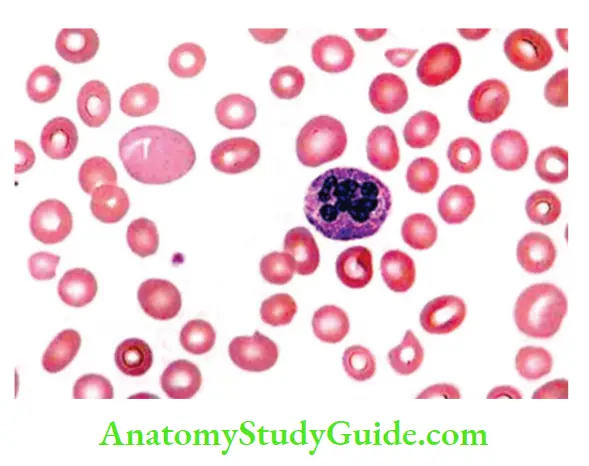 Red Blood Cells and Bleeding Disorders Peripheral smear showing a macrocyte and hypersegmented neutrophil
