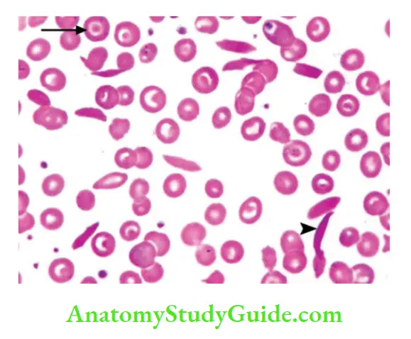 Red Blood Cells and Bleeding Disorders Sickle red cells (arrowhead) and target cells (arrow) in peripheral smear