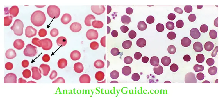 Red Blood Cells and Bleeding Disorders Spherocytes (arrow) in peripheral smear in hereditary spherocytosis
