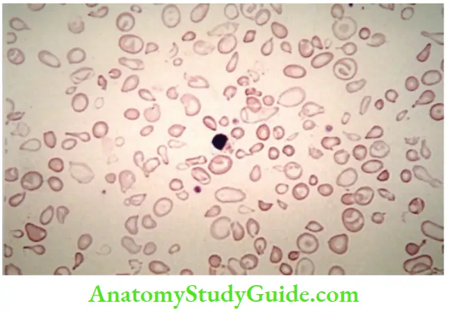 Red Blood Cells and Bleeding Disorders Target cells, microcytes, anisopoikilocytosis, nRBC in peripheral smear of thalassemia