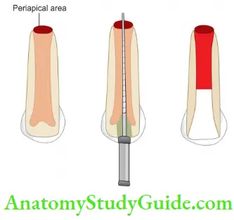 Regenerative Endodontic Line Diagram Showing Pulp Revascularization Procedure