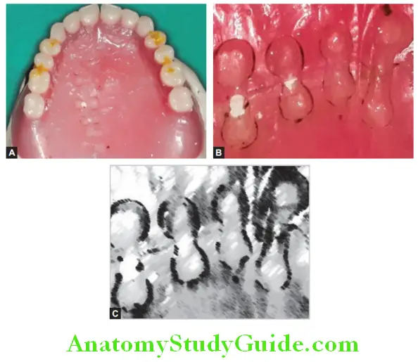 Repair Of Fractured Denture dumbbell shaped grooves along the fracture line and grooves and reformed picture to visualize the grooves