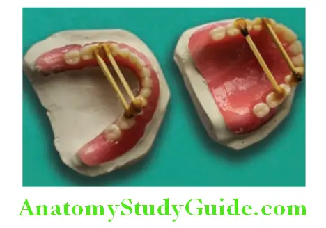 Repair Of Fractured Denture preparation of working casts