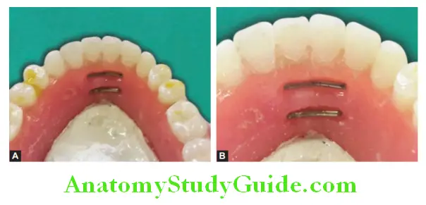 Repair Of Fractured Denture reinforcing mandibular denture with wrought wire