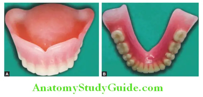 Repair Of Fractured Denture repaired maxillary and mandibular fractured dentures