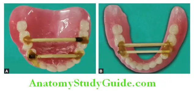 Repair Of Fractured Denture stabilization of fragments using matchsticks and sticky wax