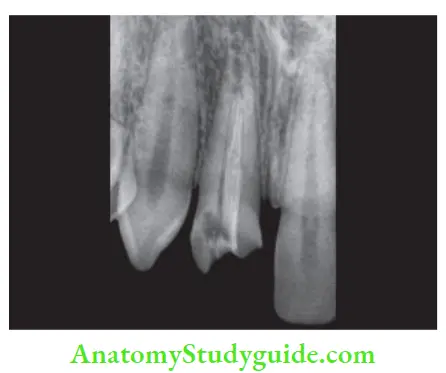 Restoration Of Endodontically Treated Teeth A tooth with poor apical seal and poor quality obturation is not indicated for post and core.