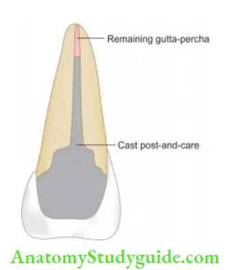 Restoration Of Endodontically Treated Teeth Cast post-and-core system.