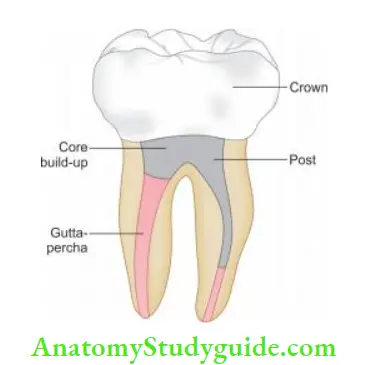 Restoration Of Endodontically Treated Teeth Complete endodontic therapy with postendodontic restoration.