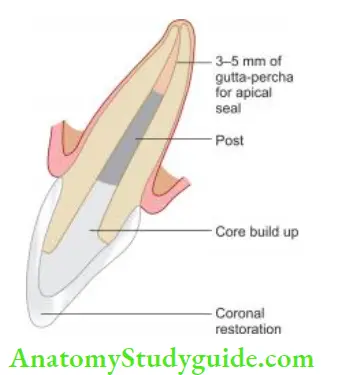 Restoration Of Endodontically Treated Teeth Components of post and core.