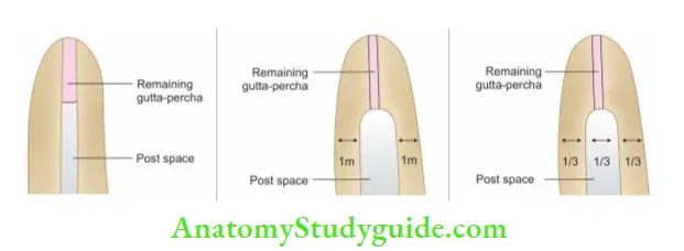 Restoration Of Endodontically Treated Teeth Conservationist approach; Preservationist approach; Proportionist approach.