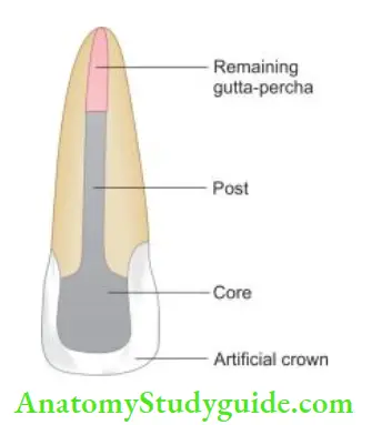 Restoration Of Endodontically Treated Teeth Custom-made post and core.