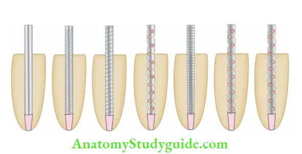 Restoration Of Endodontically Treated Teeth Diffrent types of post designs.