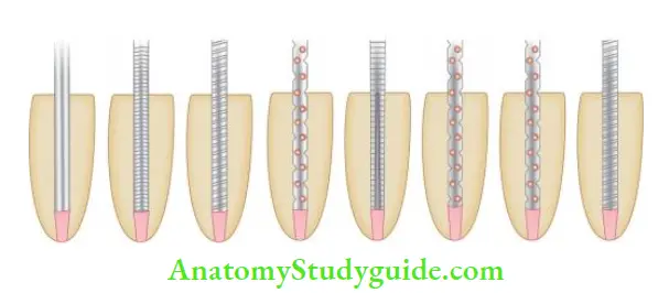 Restoration Of Endodontically Treated Teeth Diffrent types of posts designs like smooth, serrated, parallel, tapered, or combination.