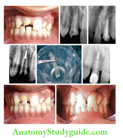Restoration Of Endodontically Treated Teeth Esthetic rehabilitation of a fractured right maxillary central incisor with custom-made fier post