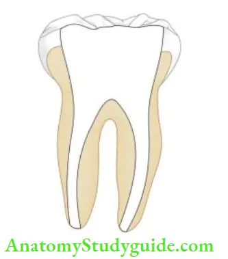 Restoration Of Endodontically Treated Teeth Excessive removal of radicular dentin may result in weakening of roots.