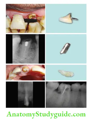 Restoration Of Endodontically Treated Teeth Failures of post and core can occur in form of