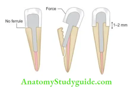 Restoration Of Endodontically Treated Teeth Ferrule dissipates the forces that concentrate at the cervical area of tooth, thus it prevents fracture of tooth.
