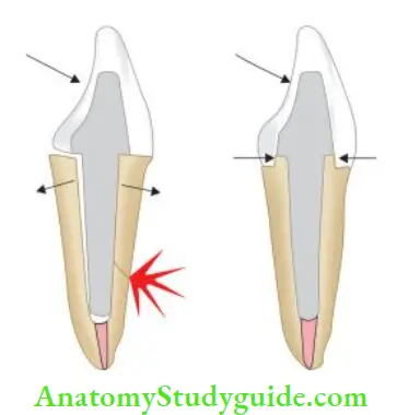 Restoration Of Endodontically Treated Teeth Ferrule protects the integrity of root by bracing action.