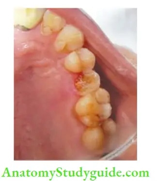 Restoration Of Endodontically Treated Teeth Grossly carious maxillary second premolar is indicated for post and core followed by crown.