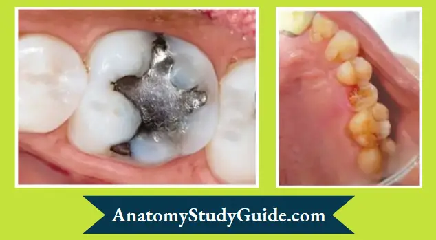 Restoration-Of-Endodontically-Treated-Teeth-Molar-with-suffient-tooth-structure-can-be-restored-using-crown